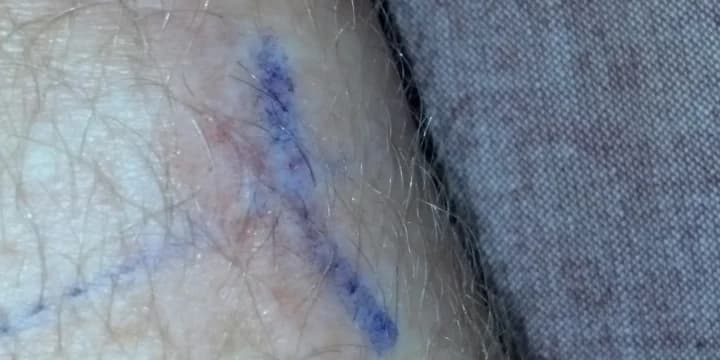 Cortisone soothes a savage wrist, but more surgery possible
